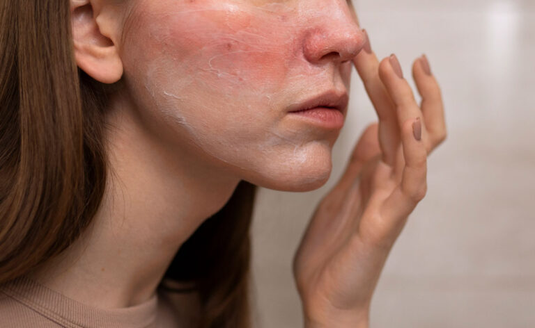 Dermatitis rash